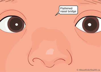 Close up of flattened nasal bridge between the eyes