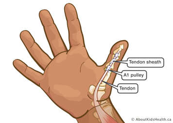 Hand showing the bones, tendon, tendon sheath and A1 pulley of a normal thumb