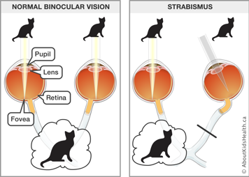 Normal binocular vision with both eyes pointed toward images of cats, and strabismus shown by one eye pointed away from cat