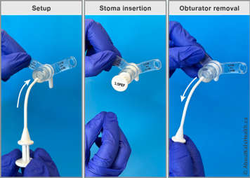 setting up the obturator for insertion, inserting the obturator into the tube and removing the obturator from the tube