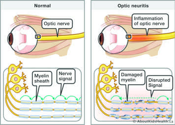 Inflamed optic nerve with damaged myelin sheaths, causing nerve signal to be disrupted