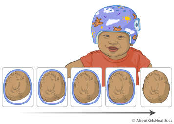Baby wearing orthotic helmet and a view of the head inside the helmet from above showing the head growing to fill the helmet to correct shape over 5 panels