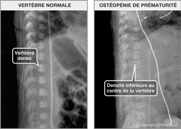 Rayon-x des vertèbres normaux et rayon-x des vertèbres d’un patient atteint d’ostéopénie de la prémutarité