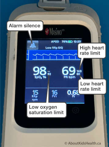 A Masimo Rad-G Oximeter showing where on the screen the alarm silence, high heart rate limit, low heart rate limit and low oxygen saturation limit is