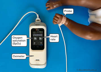 A Masimo Rad-G Oximeter attached to a baby's foot