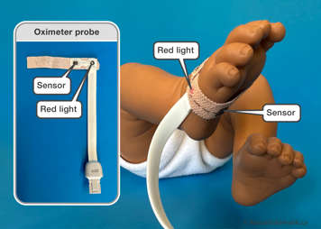 An oximeter probe showing the proper placement of the red light and the sensor on a baby's foot