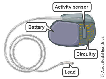 The activity sensor, battery, circuitry and lead of a pacemaker