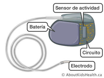 Sensor de actividad, batería, circuitos y electrodo de un marcapasos