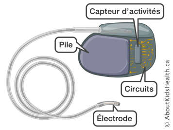 Le capteur d’activités, la pile, les circuits et l’électrode d’un stimulateur cardiaque