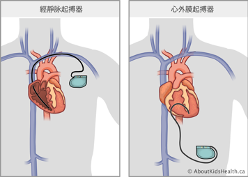 經靜脈起搏器，電極通過靜脈連接到心臟內部表面；心外膜起搏器，電極連接到心臟外部表面