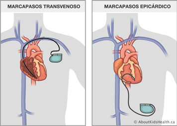 Marcapasos transvenoso pasando por una vena y entrando al corazón y marcapasos epicárdico unido al exterior del corazón