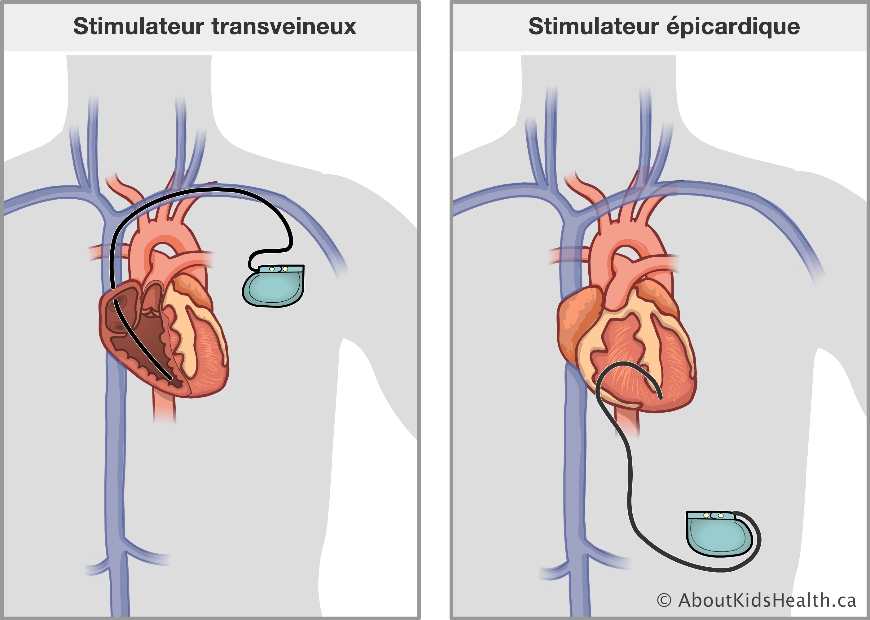 Stimulateur Cardiaque : Soins à Domicile