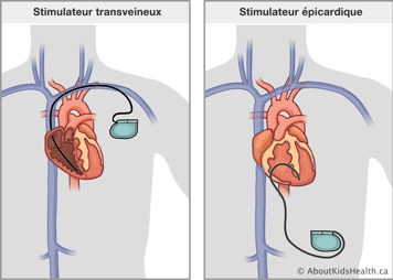 Le stimulateur transveineux dans une veine et le cœur et le stimulateur épicardiaque attaché à l’extérieur du cœur