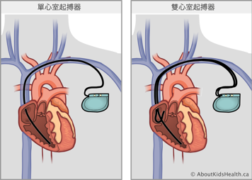 經靜脈接入心臟內部的單心室起搏器和雙心室起搏器
