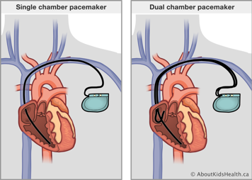 A single chamber pacemaker compared to a dual chamber pacemaker, which pass through a vein and into the heart