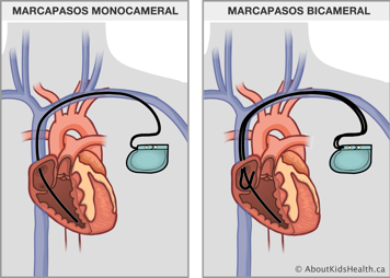 Marcapasos monocameral comparado con un marcapasos bicameral, que pasa a través de una vena y al interior del corazón