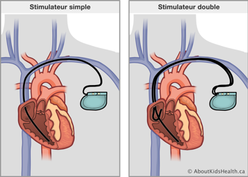 Un stimulateur simple comparé au stimulateur double, les deux passant à travers une veine et dans le cœur