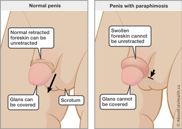 Normal penis and penis with paraphimosis