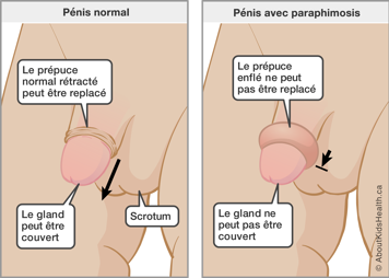 Pénis normal et pénis avec paraphimosis