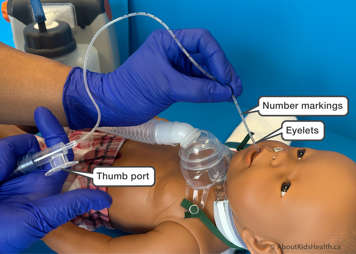 Part of a suction catheter including the number markings, eyelets and thumb port