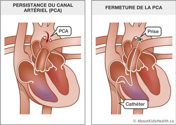 Un cœur avec persistance du canal artériel et un cœur avec un cathéter et une prise insérés pour fermer la PCA