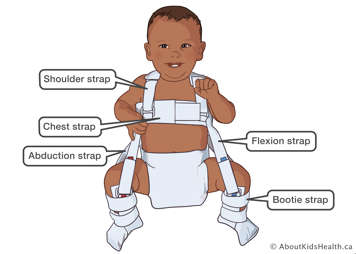 Identification of shoulder strap, chest strap, abduction strap, flexion strap and bootie strap on a Pavlik harness on a baby
