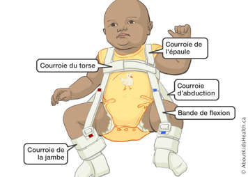 Les courroies de l’épaule, du torse, d’abduction, de flexion et de la jambe sur une attelle de Pavlik portée par un bébé