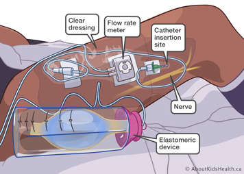 Elastomeric device showing the dressing, catheter, tubing and flow meter.