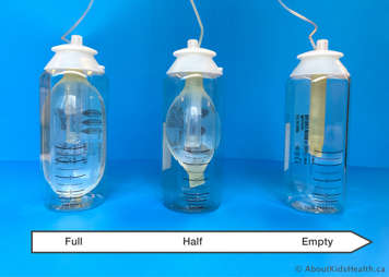 Elastomeric device showing a progression from the balloon being full, to half full and then empty