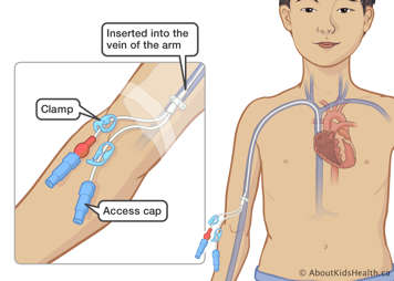 A catheter inserted into the vein of a child’s arm with a clamp and access cap on the outside
