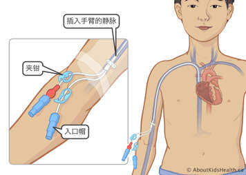 置入儿童手臂静脉中的导管，夹钳和入口帽留在体外