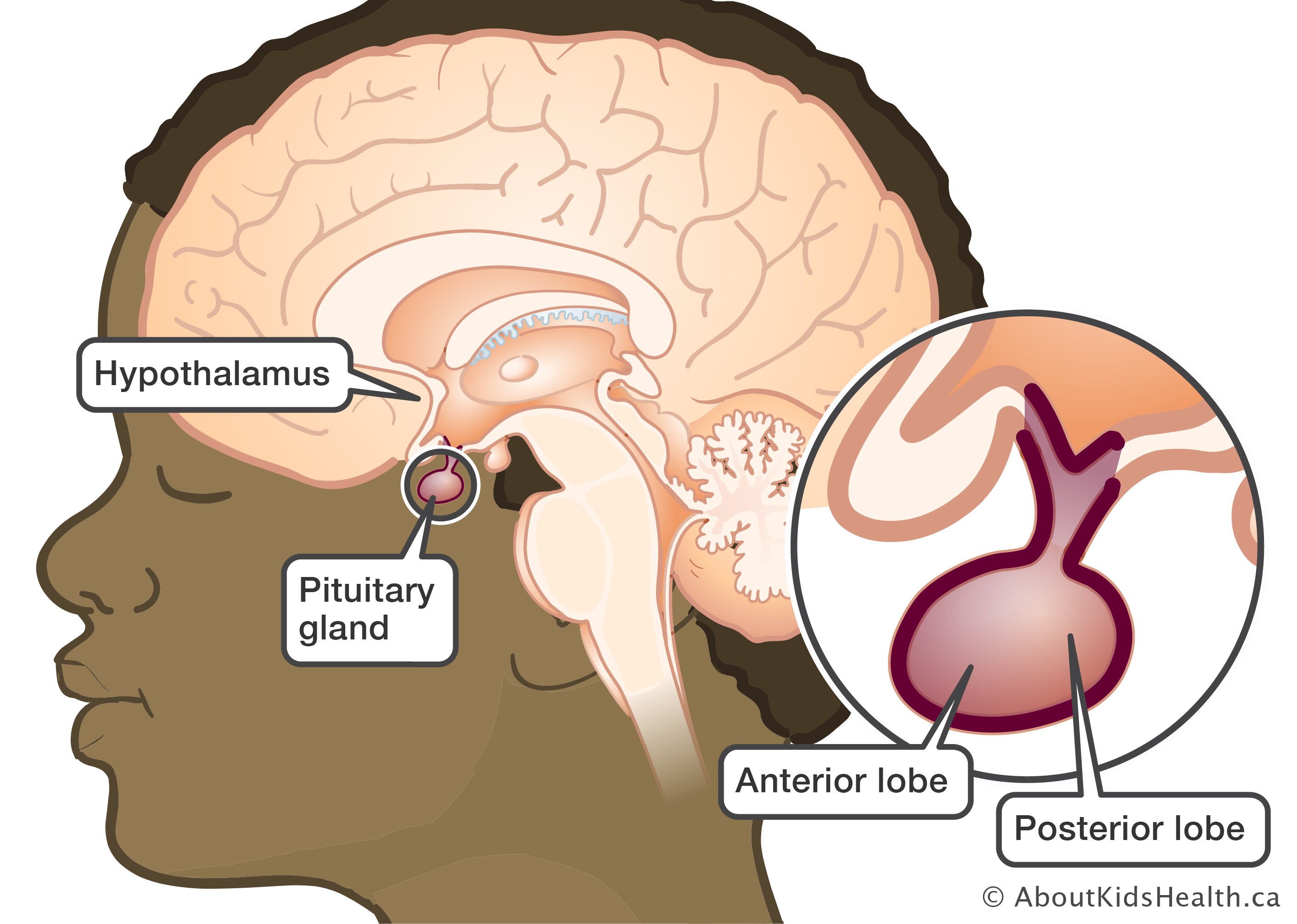 Antidiuretic hormone deficiency diabetes insipidus