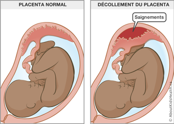 Un fœtus dans un utérus avec placenta normal et un fœtus dans un utérus avec décollement du placenta
