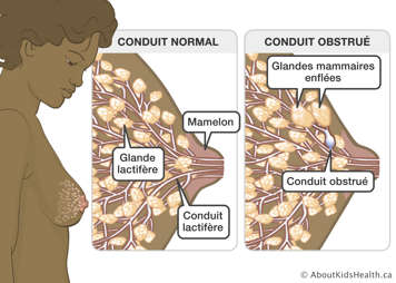 Un sein avec le conduit normal et un sein avec les glandes mammaires enflées et le conduit obstrué