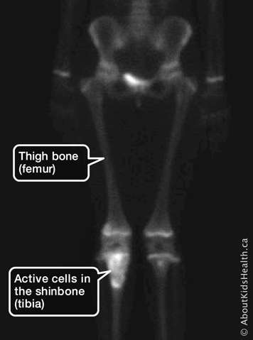 Scan of thigh bone and active cells in the shinbone