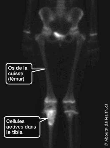 Scintigraphie de l’os de la cuisse et des cellules actives dans le tibia