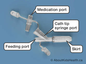 Medication port, cath tip syring port, skirt and feeding port on a Corlock Corport Y-adapter