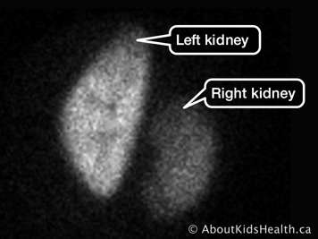 Left and right kidneys in a DMSA renal scan