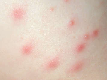 Skin affected by folliculitis