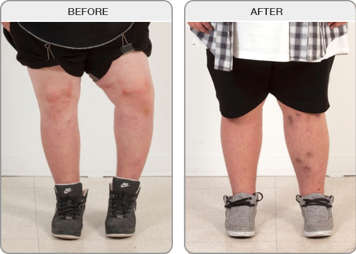 Legs before and after limb deformity correction