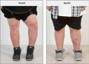 Les jambes avant et après la correction d’une difformité