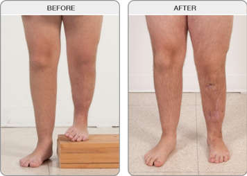 Legs before and after limb lengthening