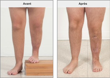 Les jambes avant et après allongement