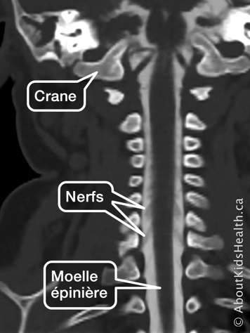 Identification du crâne, de la moelle épinière et des nerfs dans une myélographie par tomodensitométrie