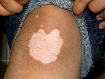 Le vitiligo sur un genou de peau foncée