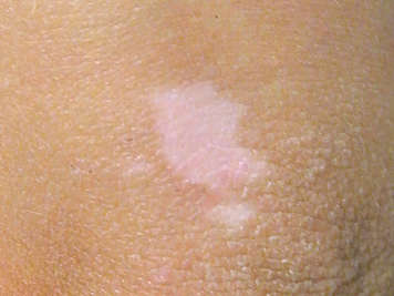 Le vitiligo sur un genou de peau plus pâle