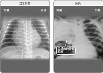 正常雙肺的X光透視影像，以及右肺感染肺炎的X光透視影像