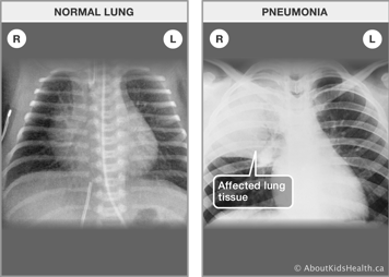 An X-ray of normal left and right lungs and an X-ray of lungs with pneumonia in the right side