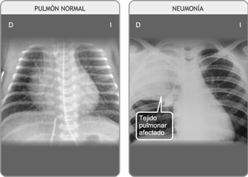 Una radiografía de ambos pulmones en estado normal y una radiografía de los pulmones con neumonía en el pulmón derecho