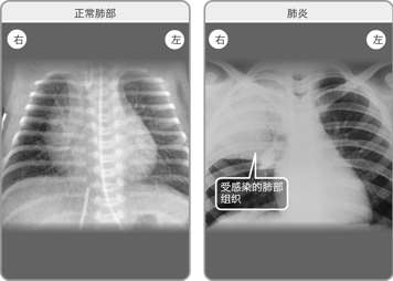 正常双肺的X光透视影像，以及右肺感染肺炎的X光透视影像